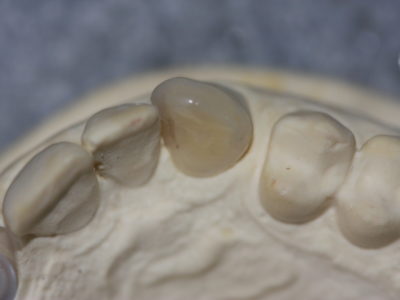Vollkeramik1(4)