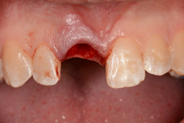 Implantat2(1)
